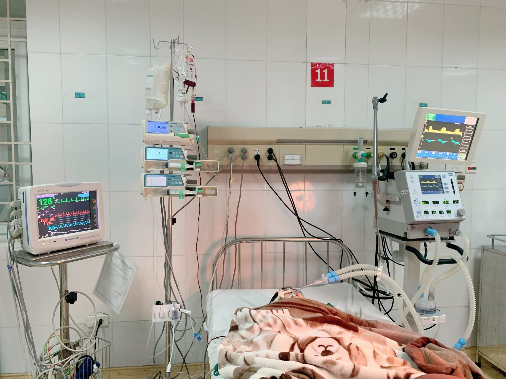 Cứu sống bé gái bị sốc nhiễm trùng, nhiễm độc do xoắn ruột hoại tử tại Bệnh viện Sản Nhi Bắc Giang