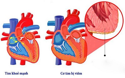 COVID-19 có thể ảnh hưởng đến tim, ngay cả sau khi đã hồi phục