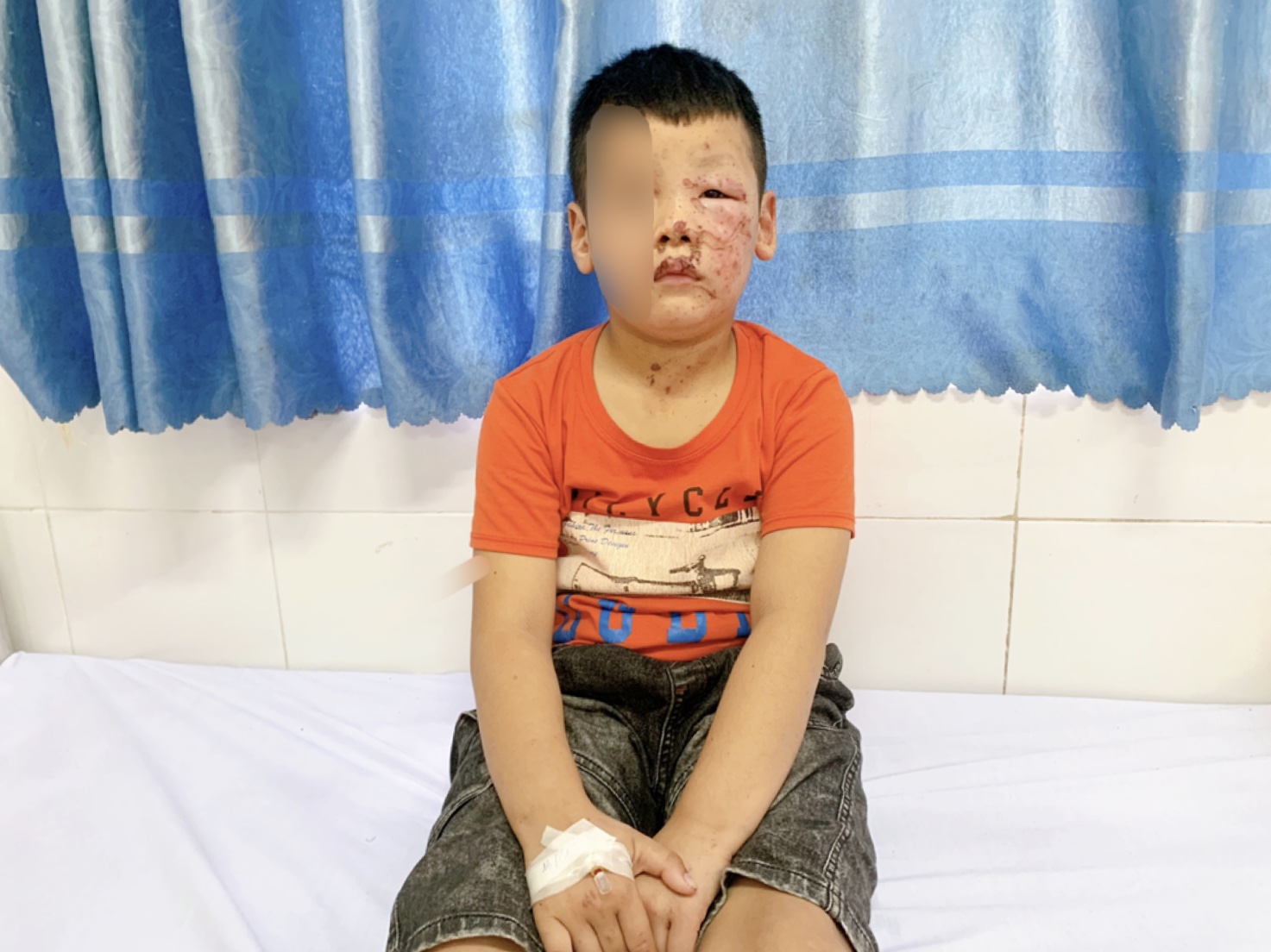 Khuyến cáo phòng, chống bị bỏng ở trẻ em