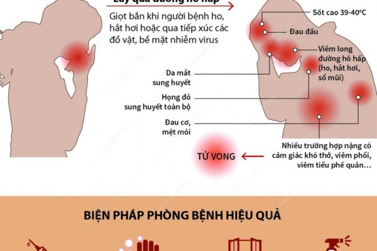 Các dấu hiệu, triệu chứng và cách phòng bệnh Cúm A