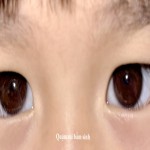 Phẫu thuật quặm mi bẩm sinh ở trẻ em - Giải pháp an toàn, hiệu quả tại Bệnh viện Sản Nhi Bắc Ninh Số 1