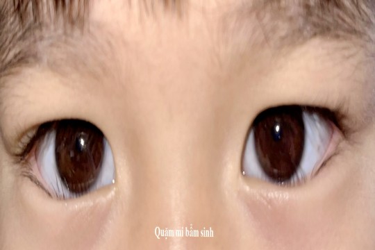 Phẫu thuật quặm mi bẩm sinh ở trẻ em - Giải pháp an toàn, hiệu quả tại Bệnh viện Sản Nhi Bắc Ninh Số 1