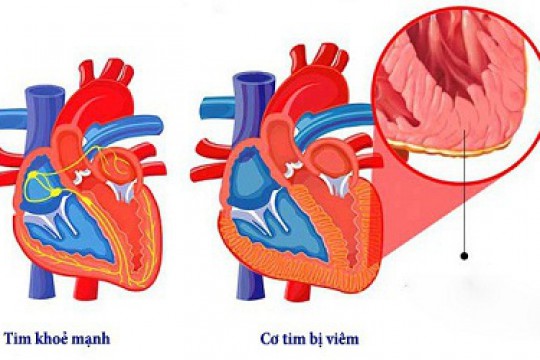 COVID-19 có thể ảnh hưởng đến tim, ngay cả sau khi đã hồi phục