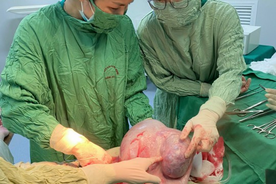Phẫu thuật khối u nang buồng trứng nặng 6,5kg tại Bệnh viện Sản Nhi Bắc Giang