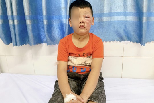 Khuyến cáo phòng, chống bị bỏng ở trẻ em