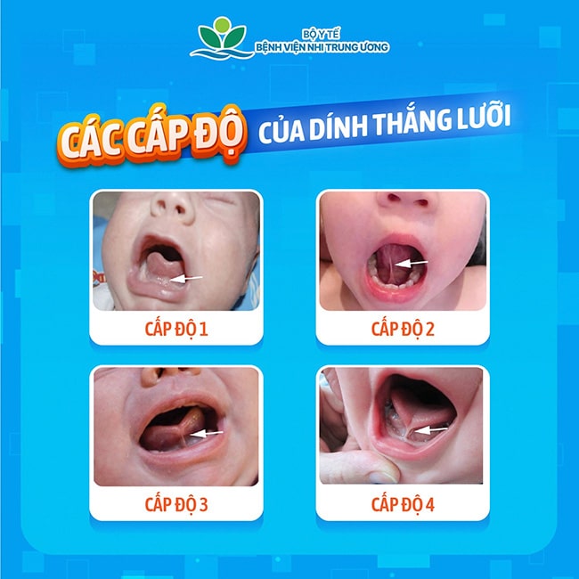 thắng lưỡi 2